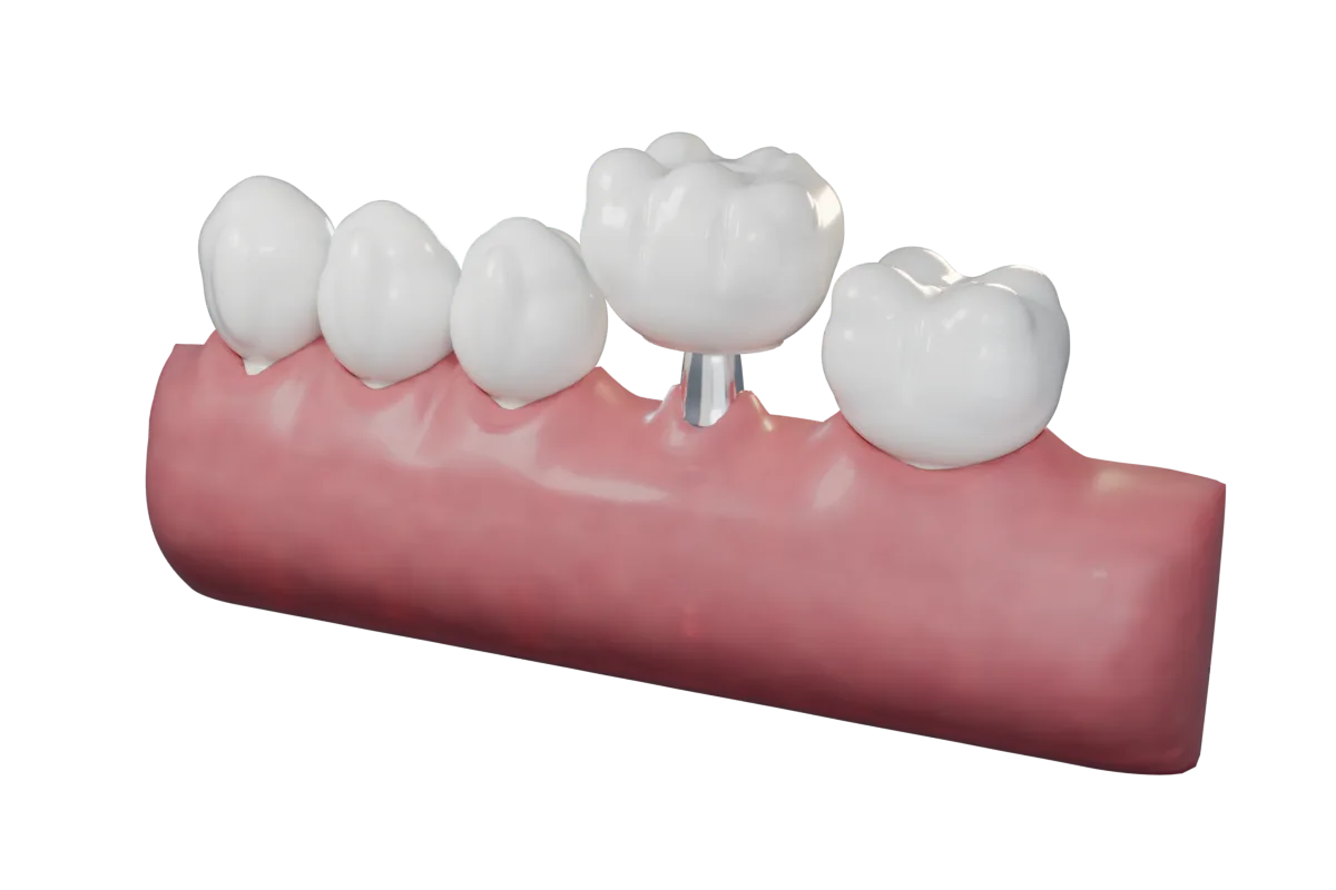 Çenede köpek dişi, azı dişi ve implant; kesitte mine, dentin, pulpa, damar ve sinirler
